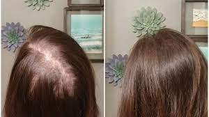 How To Deal With That Crazy Part In The Back Of Your Head Parting Hair Hairstyles For Thin Hair Hair Thinning On Top