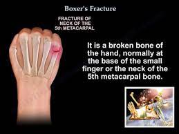We did not find results for: Boxer S Fracture Everything You Need To Know Dr Nabil Ebraheim Youtube