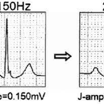 You can find more videos like best of cassi on ecg below in the related videos section. Pdf Anmco Aiic Sit Consensus Information Document Definition Precision And Suitability Of Electrocardiographic Signals Of Electrocardiographs Ergometry Holter Electrocardiogram Telemetry And Bedside Monitoring Systems