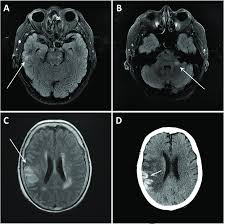 Looking to download safe free latest software now. Brain Imaging In A Case Of Hsv Encephalitis A And B Demonstrate T2 Download Scientific Diagram