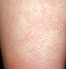 How To Get Rid Of Bumps On Arms Patchy Skin Red Patchy Skin Skin Bumps On Arms
