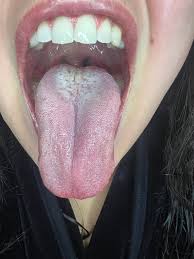 Image result for yellow tongue infection