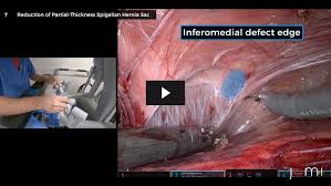 Image result for Hernia Reduction