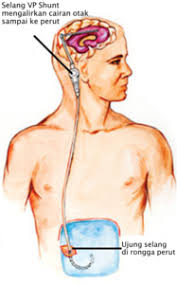 Apakah Normal Pressure Hydrocephalus Nph Brain And Spine Center