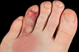 Fractures can range from tiny cracks in your bones to breaks that pierce your skin. How To Know If I Broke My Toe Quora
