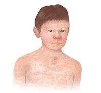 ADENITIS CERVICAL Caso clínico