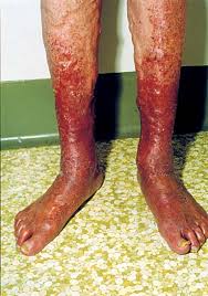 Image result for Stasis Dermatitis