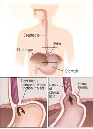 Image result for stomach hernia symptoms