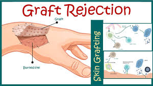 Image result for Transplant Rejection