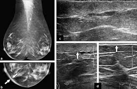 Maybe you would like to learn more about one of these? Inflammatory Breast Disease The Radiologist S Role Sciencedirect