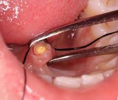 Image result for Sialolithiasis