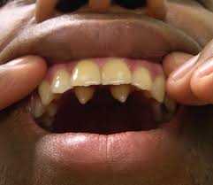 If we don't take care of our teeth and gums, we risk tooth decay, gum disease, and even bone loss. How Freddie Mercury Got His Voice It Wasn T His Teeth Genetic Literacy Project