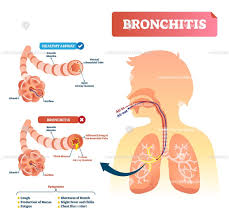 Bronchitis Anatomical Vector Illustration Medical Diagram Respiratory Illness Bronchitis Medical Knowledge