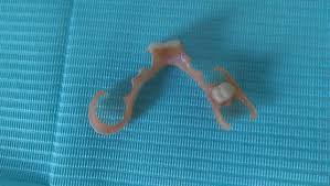 Check spelling or type a new query. Removable Partial Denture Wikiwand