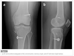 A accelerating charge radiates electromagnetic radiation. Instability Following Acl Rupture What Do We Need To Restore During Reconstruction