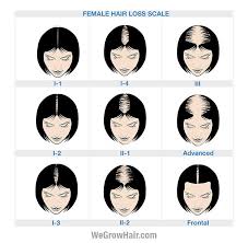 Pubic hair and body hair for example, will continuously keep on growing throughout life. Ludwig Scale Female Hair Loss