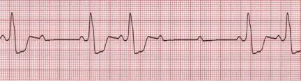 Blocul atrioventricular de gradul ii poate determina palpitatii, dar daca blocul este de grad inalt , simptomatologia este aceeasi ca si in blocul atrioventricular complet. Av Block 2nd Degree Mobitz Ii Hay Block Litfl