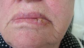 It's not unusual for a single keratoacanthoma to shrink and disappear on its own after several months. Lip Cancer What It Looks Like And What To Do