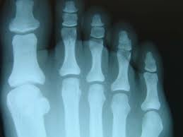 How are stress fractures diagnosed? Photo Quiz An Unusual Swelling Of The Foot The Foot And Ankle Online Journal