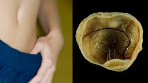 Cyst with hair and teeth pictures. Hair Bones And Teeth Inside Ovarian Cyst What Exactly Is A Dermoid Cyst Latestly