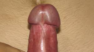 File:Fotografía de alta calidad real del frenillo en un pene de 22 años  .jpg - Wikimedia Commons