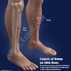Treatment for a bone bruise may include: 1