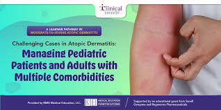 Image result for Atopic Patient