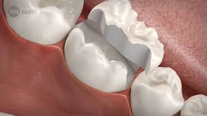 Loch Im Zahn In Chemnitz Zahnfarbene Fullungen