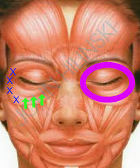 Cortisone shots work by decreasing inflammation.﻿﻿ many patients mistakenly think that cortisone only serves to cover up the while the effects of cortisone typically take a few days or longer to begin to take effect, many patients will report almost immediate relief of pain. Botox And Under Eye Wrinkles