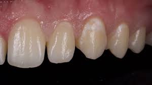 They are usually placed when patients are awaiting further procedures. White Fillings Before And After Photos Front Tooth Composite Fillings