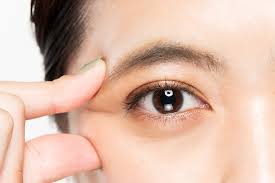 See more of mata juling on facebook. Banlag Na Mata At Duling What Is Strabismus Cross Eyed And Wall Eyed