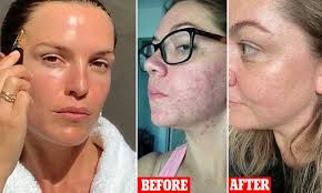 Dec 16, 2020 · vitamin c is generally safe when consumed in foods or applied topically. Imbibe My Secret To Glowing Radiant Skin How Woman Banished Her Acne With A 40 Miracle Product Daily Mail Online