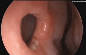 The symptoms of nasal vestibulitis do not improve after a few days of taking antibiotics. Nasal Septum Perforation Causes Pathology Symptoms Treatment