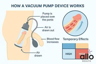 An anatomical illustration detailing how vacuum therapy pulls blood into the penile tissue., AI generated