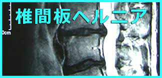 椎間板ヘルニアと言われても解決策があります | 慢性症状はストレスが原因｜気づかないストレスにアプローチ つちこカイロプラクティック