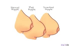 Image result for Nipple Inversion