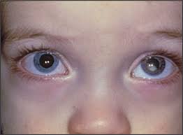 Blockage and discharge from the nose and throat, and occasionally an eye may. Retinoblastoma American Family Physician