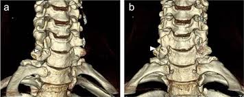 Check spelling or type a new query. Accessory Articulation Of The Cervical Transverse Process A Very Rare Anatomic Variant