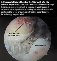 Image result for Hip Labral Tear
