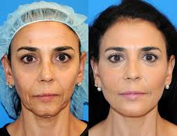 Y Lift Mara Before 2 Days After Mara Was Featured Along Side Dr Yan Trokel And The Y Lift On An Non Surgical Facelift Facial Contouring Facial Fillers