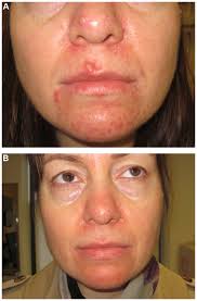 I have only had rosacea for a few years, came on a little while after i had a baby. Update On The Management Of Rosacea Ccid