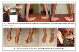 The cost of treating club foot depends on whether your child will need one or both legs braced. Treatment Of Neglected And Relapsed Clubfoot With Midfoot Osteotomy A Retrospective Study