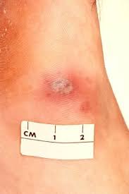 Gonorrhea (Neisseria Gonorrhea) | Pathophysiology, Symptoms &  Complications, Diagnosis, Treatment - Youtube