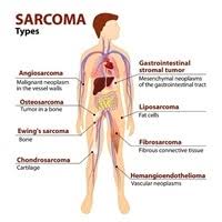 Some sarcomas and carcinomas can express more than one line of differentiation (that is, a sarcoma looking like muscle and fat, or a carcinoma looking both squamous and glandular). Sarcomas Latest Developments In Diagnosis And Treatment
