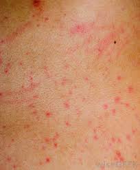 Radiation dermatitis describes specific changes on the skin that can occur after radiation therapy for cancer. What Is The Connection Between Itchy Skin And Cancer