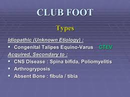 Postural or positional clubfeet are not true clubfeet. Congenital Talipes Equino Varus Congenital Clubfoot Ppt Video Online Download