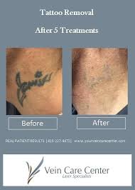 Though it is one of the most effective processes, it is also painful and heavy on your pockets. How Effective Is Laser Tattoo Removal Laser Specialists