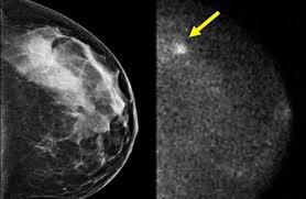 They will look carefully at the mammogram to interpret the results. How Do You Know When To Get Screened For Breast Cancer Macleans Ca