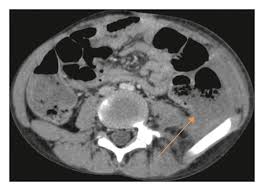 Image result for Neutropenic Colitis