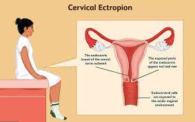 Health Zone Turkey What Is A Wound In The Cervix Servical Erosion How Is It Treated